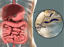 Helicobacter pylori